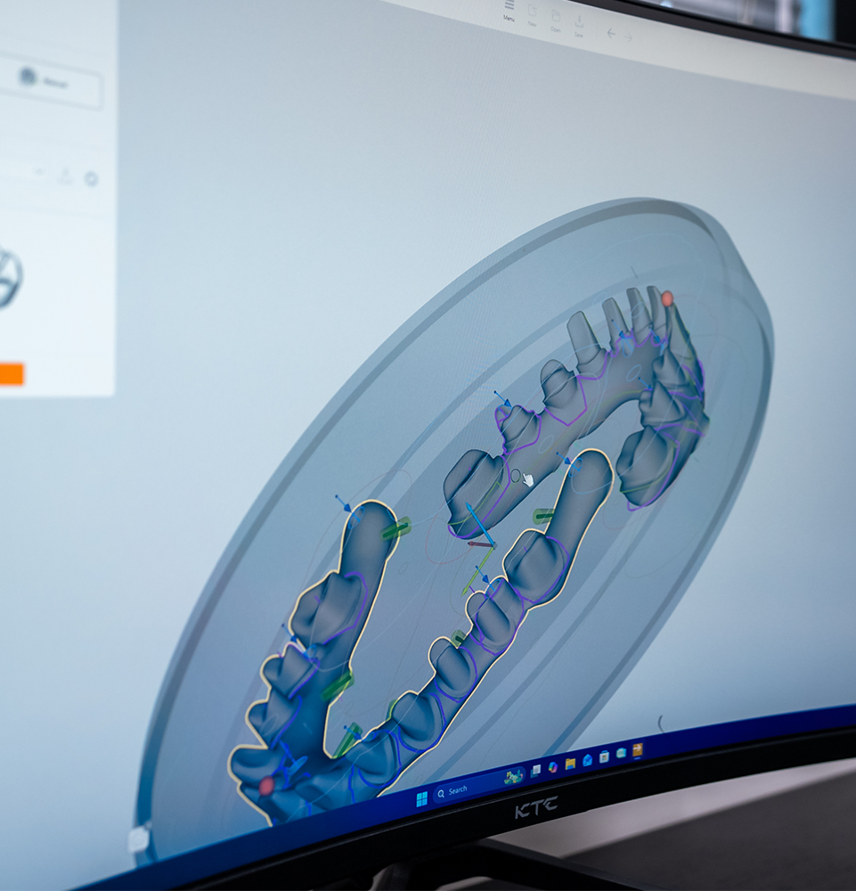 implant software on the computer for implant planning