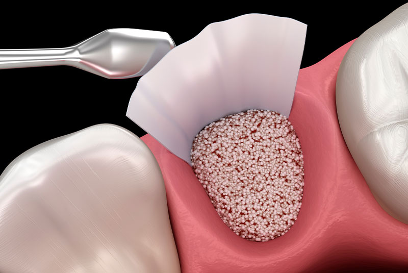 Bone Grafting