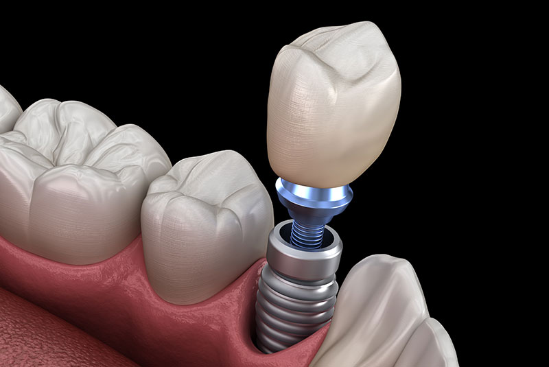 Dental Implants