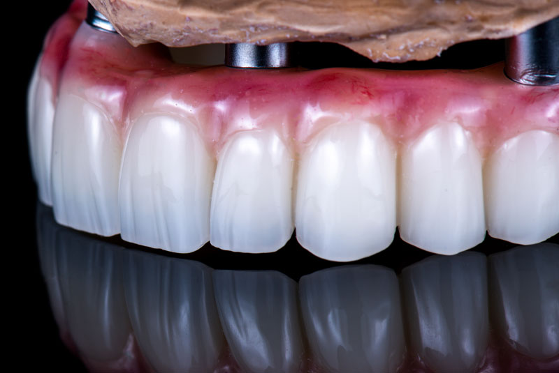 Full-Arch Dental Implants