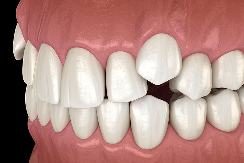 Impacted Canines