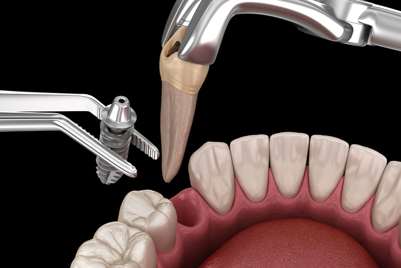 Tooth Extractions